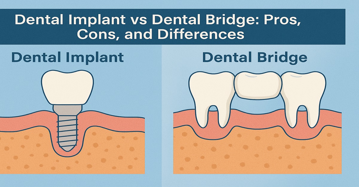 Dental Implant vs Dental Bridge: Pros, Cons, and Differences
