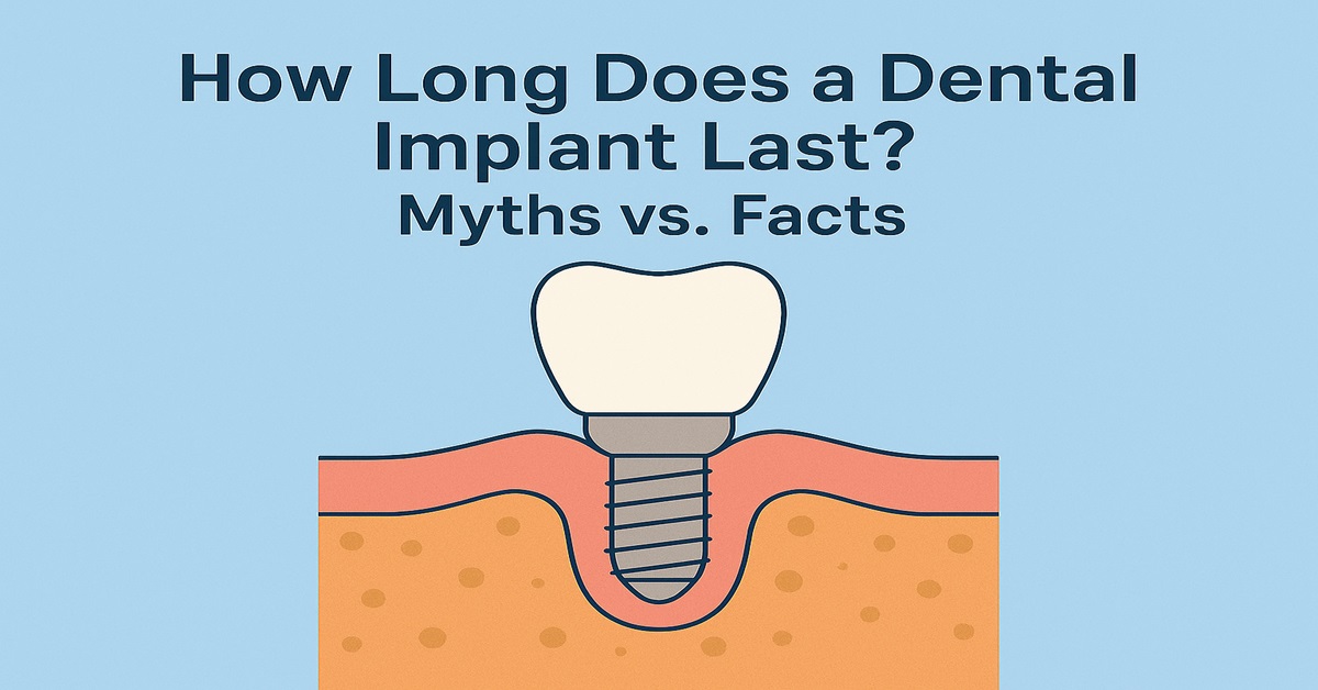 How Long Does a Dental Implant Last? Myths vs. Facts