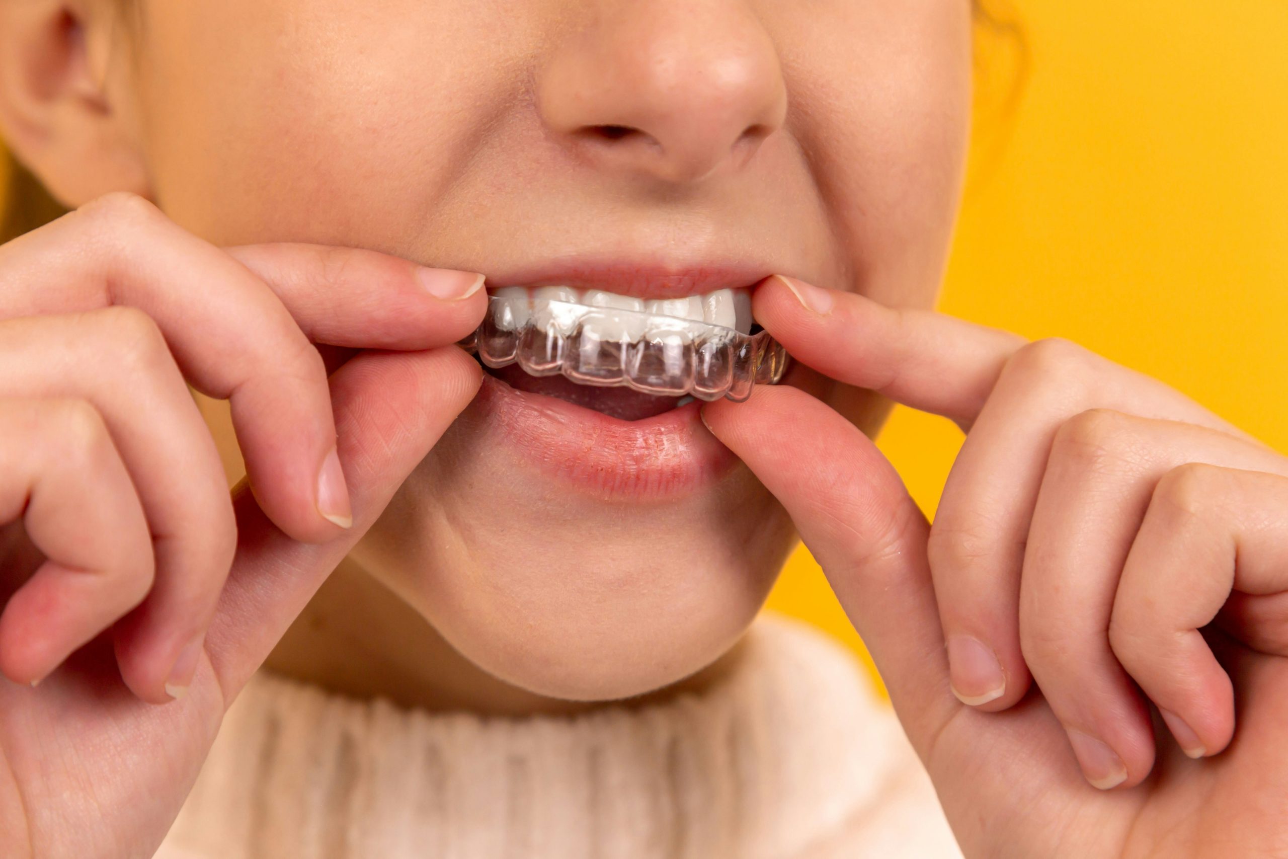 Benefits of Invisalign Over Traditional Braces