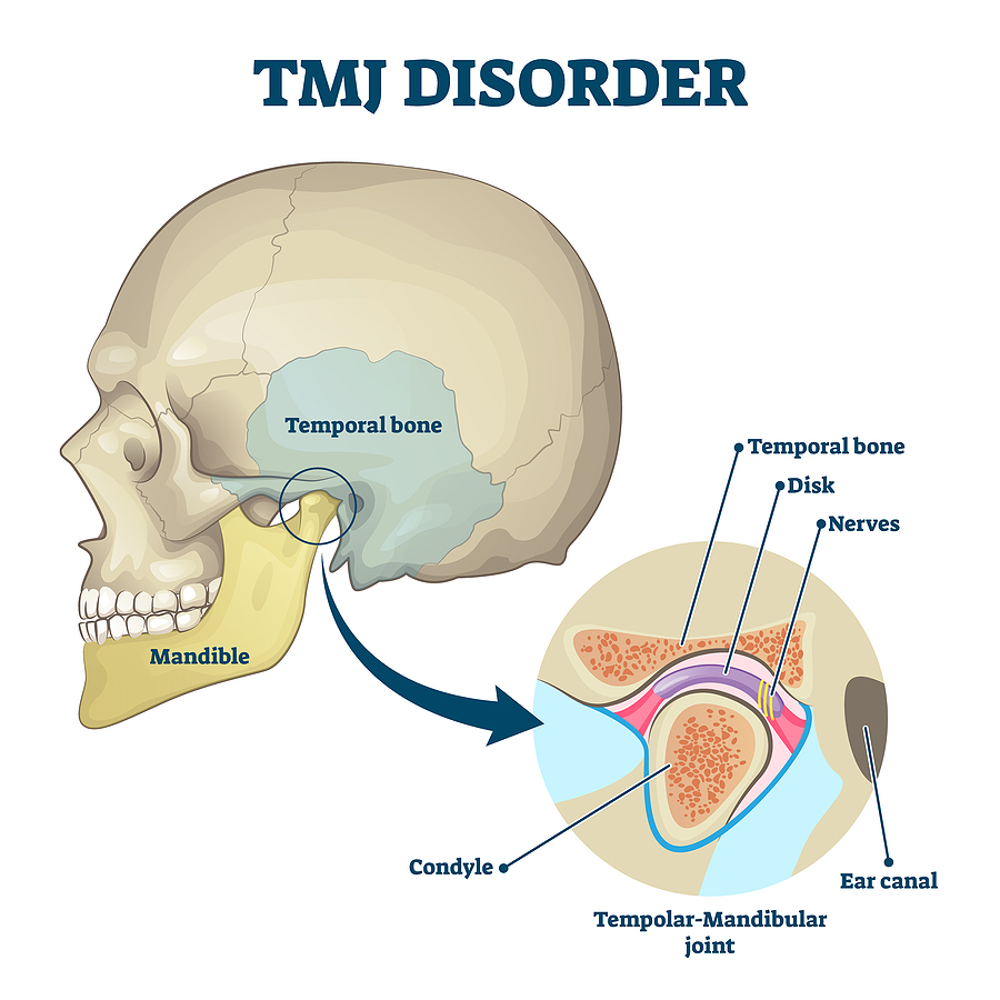Understanding TMJ Disorders and Finding Relief in Tampa, FL